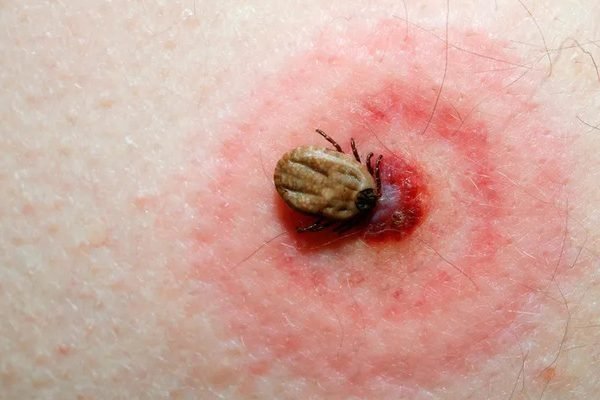 peligros-de-las-picaduras-de-garrapatas