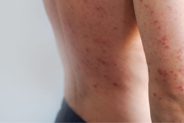 sarampion-covid-19-enfermedad-mas-contagiosa-sintomas